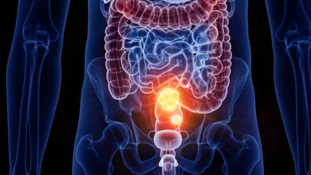 tumore-al-colon:-gli-alimenti-che-possono-aumentare-le-possibilita